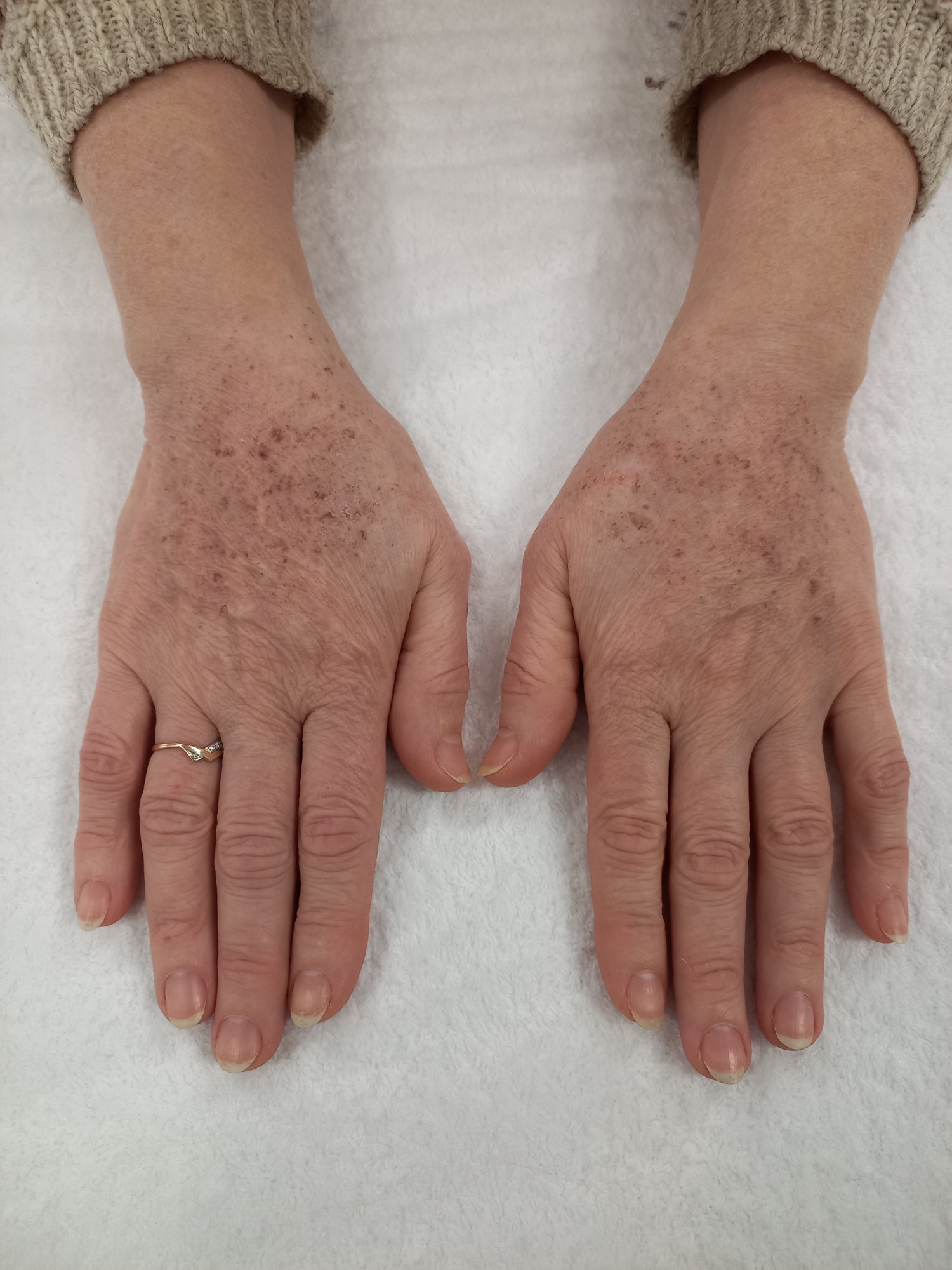 Омоложение кожи кистей рук и лечение гиперпигментации с помощью применения методики IPL фото до.jpg
