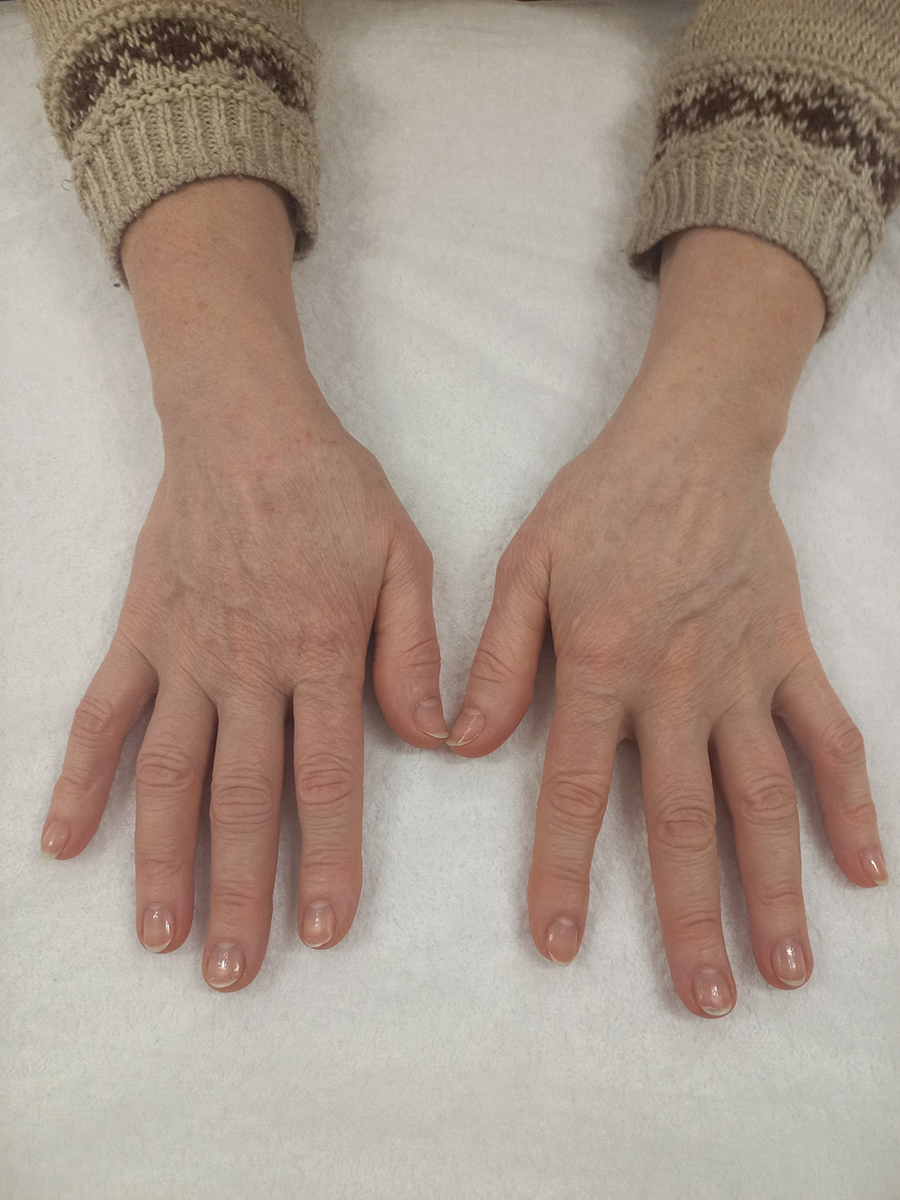Омоложение кожи кистей рук и лечение гиперпигментации с помощью применения методики IPL фото после.jpg